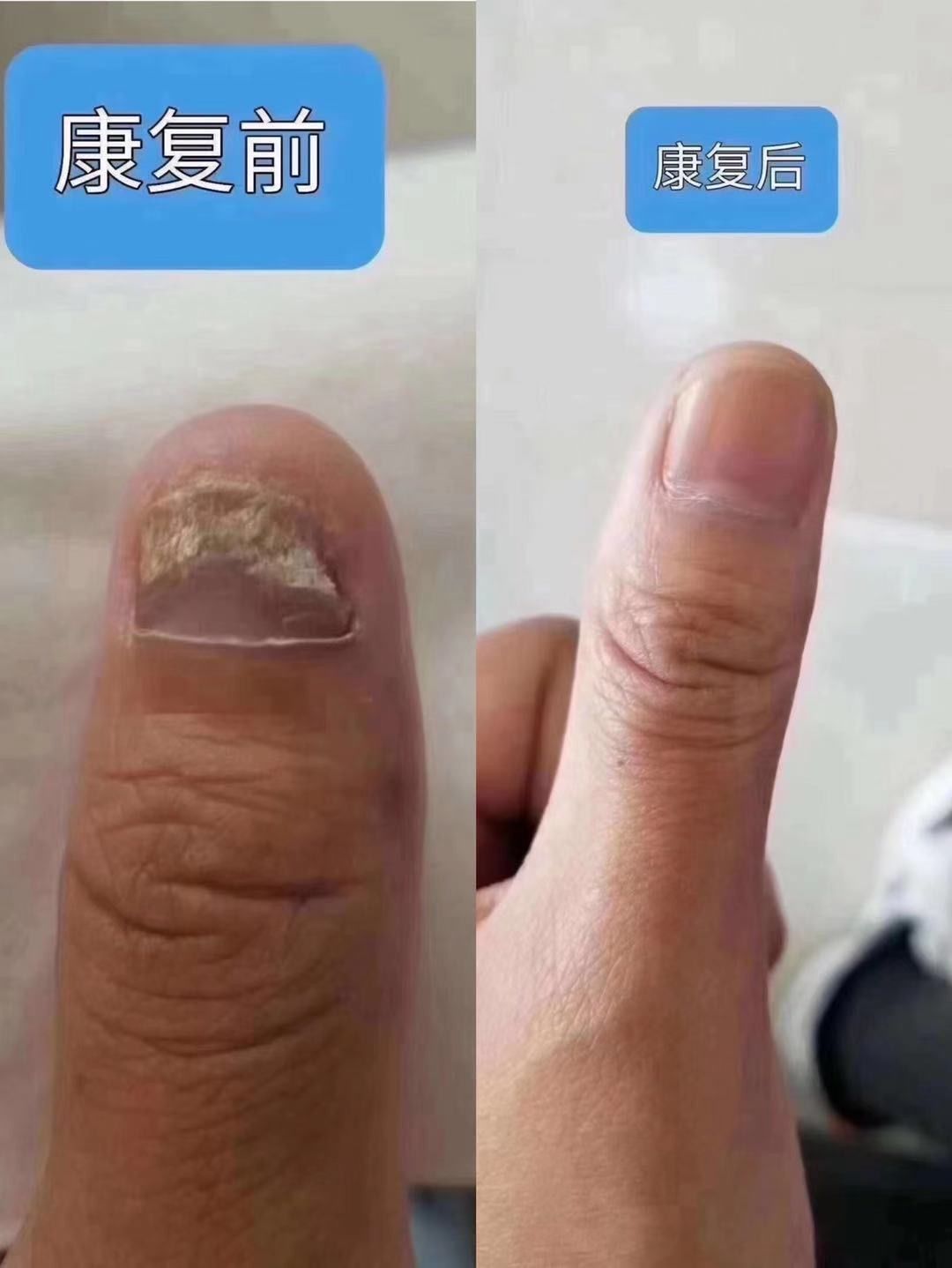 灰指甲吃什么对身体好 灰指甲吃什么食物指甲长得比较快